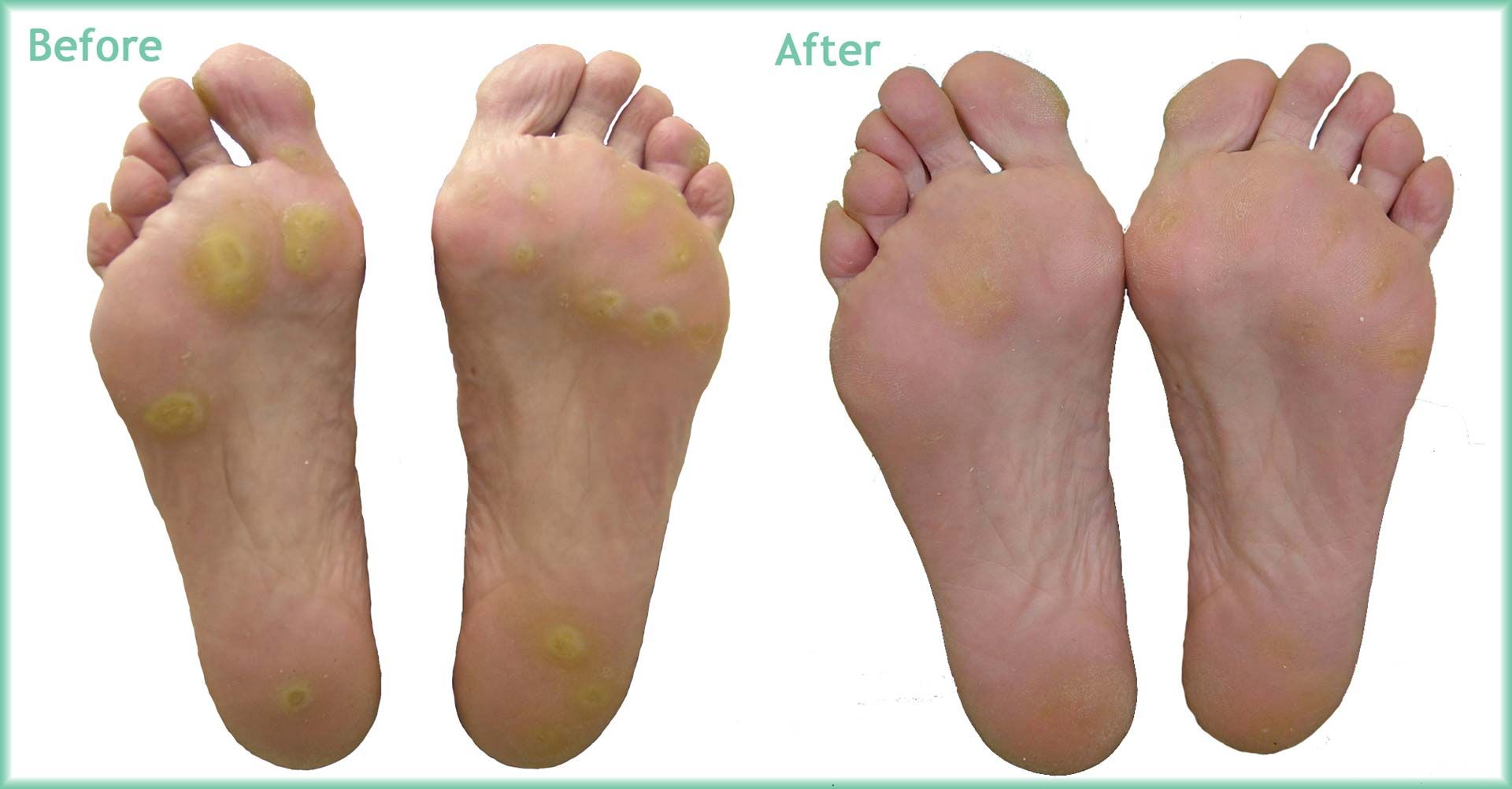 Corns O'Driscoll's Podiatry Cork Chiropodis