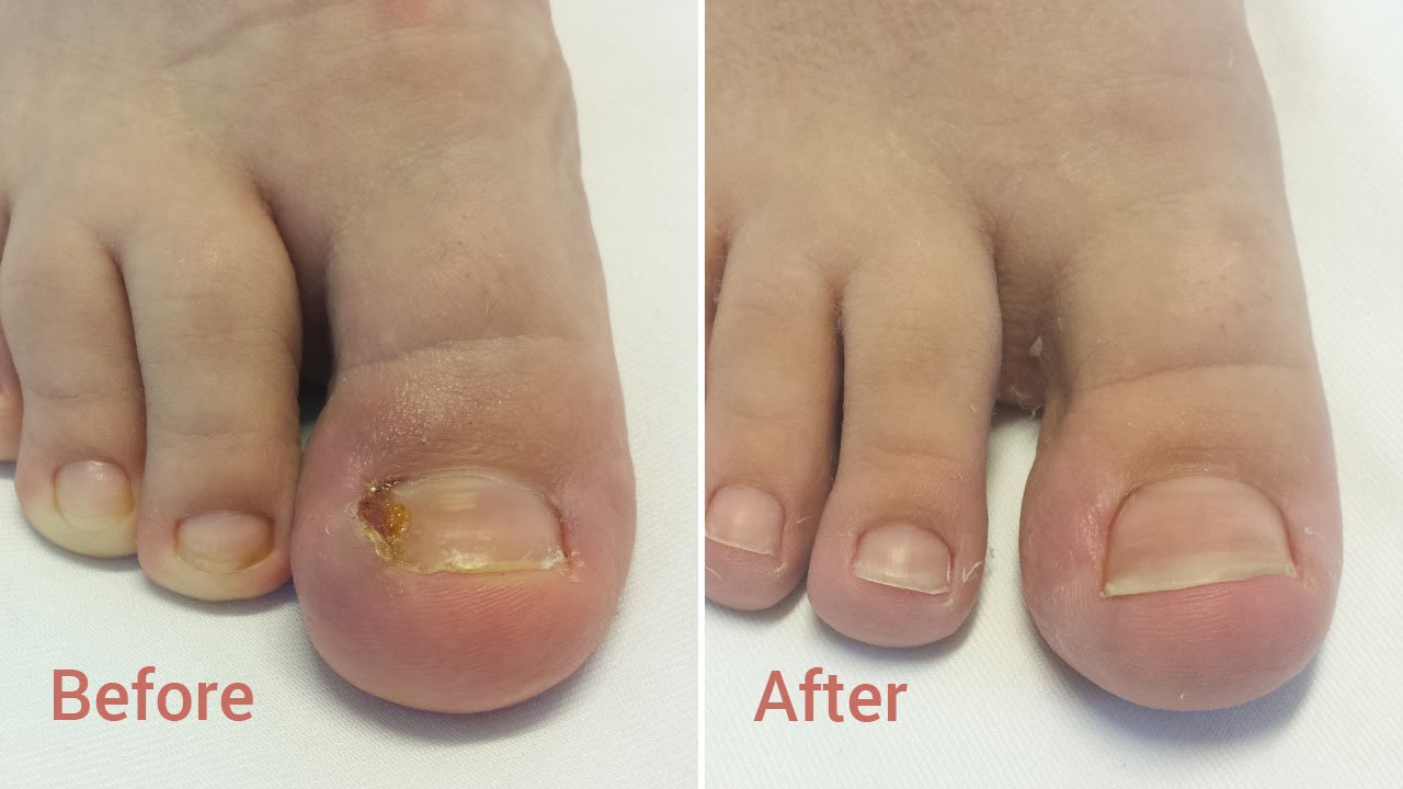 Exploring Ingrown Toenail Treatment: A Look at Alternative Remedies